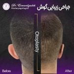 جراحی زیبایی گوش یا اتوپلاستی چیست؟