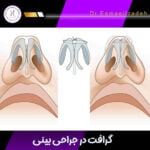 اهمیت گرافت در جراحی بینی